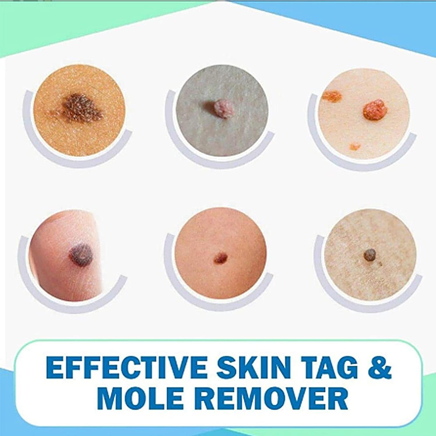 Tags and Moles Remover Device Natural Effective Scar-Free for Face Skin Care Tags and Moles Remover Device Natural Effective Scar-Free for Face Skin Care